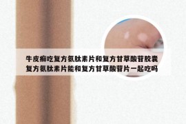 牛皮癣吃复方氨肽素片和复方甘草酸苷胶囊 复方氨肽素片能和复方甘草酸苷片一起吃吗