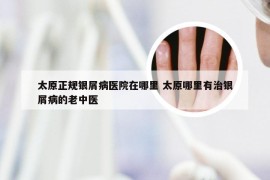 太原正规银屑病医院在哪里 太原哪里有治银屑病的老中医