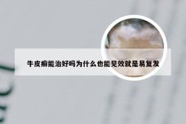 牛皮癣能治好吗为什么也能见效就是易复发