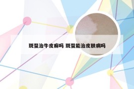 斑蝥治牛皮癣吗 斑蝥能治皮肤病吗
