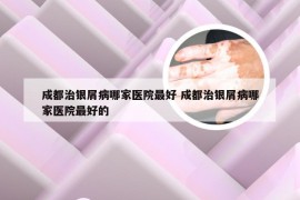 成都治银屑病哪家医院最好 成都治银屑病哪家医院最好的