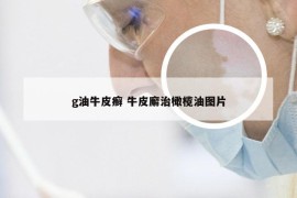 g油牛皮癣 牛皮廨治橄榄油图片