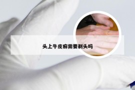 头上牛皮癣需要剃头吗