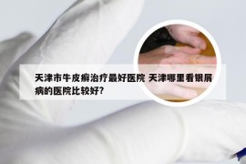 天津市牛皮癣治疗最好医院 天津哪里看银屑病的医院比较好?