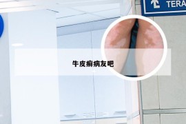牛皮癣病友吧