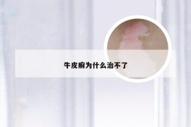 牛皮癣为什么治不了