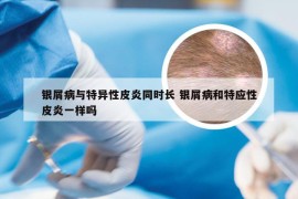 银屑病与特异性皮炎同时长 银屑病和特应性皮炎一样吗