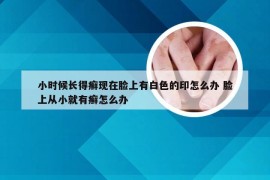 小时候长得癣现在脸上有白色的印怎么办 脸上从小就有癣怎么办