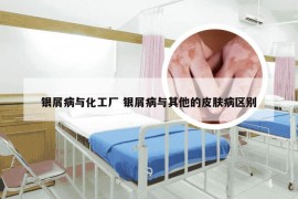 银屑病与化工厂 银屑病与其他的皮肤病区别