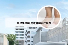 惠民牛皮癣 牛皮肤癣治疗医院