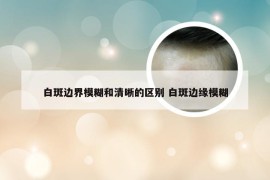 白斑边界模糊和清晰的区别 白斑边缘模糊