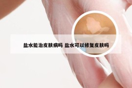 盐水能治皮肤病吗 盐水可以修复皮肤吗