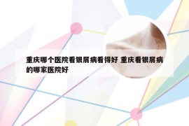 重庆哪个医院看银屑病看得好 重庆看银屑病的哪家医院好