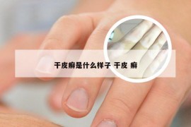 干皮癣是什么样子 干皮 癣