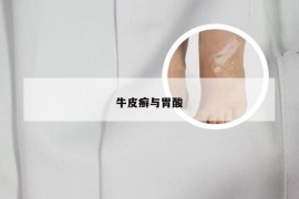 牛皮癣与胃酸