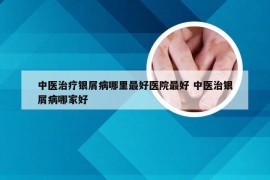 中医治疗银屑病哪里最好医院最好 中医治银屑病哪家好