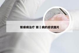 银瘠病治疗 银廯病的症状图片