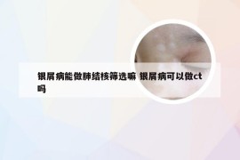 银屑病能做肺结核筛选嘛 银屑病可以做ct吗