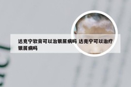 达克宁软膏可以治银屑病吗 达克宁可以治疗银屑病吗