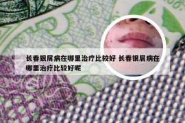 长春银屑病在哪里治疗比较好 长春银屑病在哪里治疗比较好呢