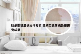 脓疱型银屑病治疗专家 脓疱型银屑病最新研究成果