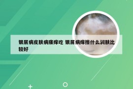 银屑病皮肤病瘙痒吃 银屑病痒擦什么润肤比较好