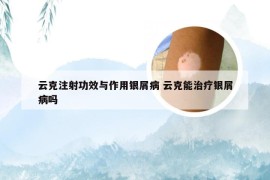 云克注射功效与作用银屑病 云克能治疗银屑病吗