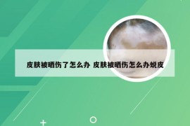 皮肤被晒伤了怎么办 皮肤被晒伤怎么办蜕皮
