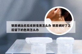 银屑病治愈后皮肤变黑怎么办 银屑病好了之后留下的色斑怎么办