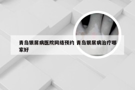 青岛银屑病医院网络预约 青岛银屑病治疗哪家好