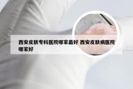 西安皮肤专科医院哪家最好 西安皮肤病医院哪家好