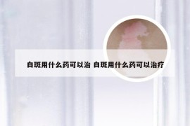 白斑用什么药可以治 白斑用什么药可以治疗