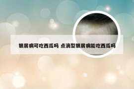 银屑病可吃西瓜吗 点滴型银屑病能吃西瓜吗