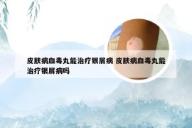 皮肤病血毒丸能治疗银屑病 皮肤病血毒丸能治疗银屑病吗