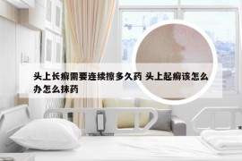 头上长癣需要连续擦多久药 头上起癣该怎么办怎么抹药