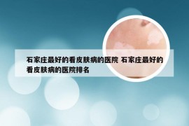 石家庄最好的看皮肤病的医院 石家庄最好的看皮肤病的医院排名