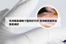 苏州银屑病哪个医院好不好 苏州哪家医院治银屑病好