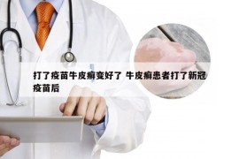 打了疫苗牛皮癣变好了 牛皮癣患者打了新冠疫苗后