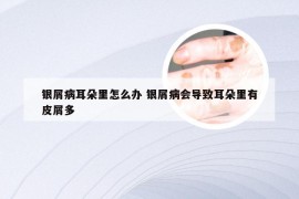 银屑病耳朵里怎么办 银屑病会导致耳朵里有皮屑多