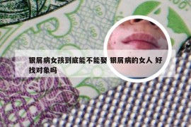 银屑病女孩到底能不能娶 银屑病的女人 好找对象吗