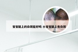 宝宝腿上的白斑能好吗 小宝宝腿上有白斑