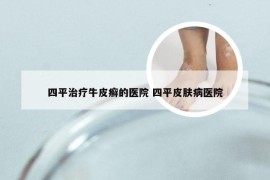 四平治疗牛皮癣的医院 四平皮肤病医院