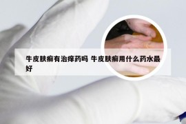 牛皮肤癣有治痒药吗 牛皮肤癣用什么药水最好