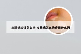 皮肤病应该怎么治 皮肤病怎么治疗用什么药