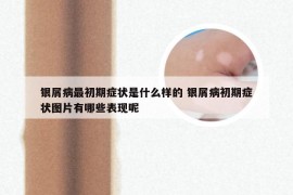 银屑病最初期症状是什么样的 银屑病初期症状图片有哪些表现呢
