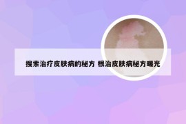 搜索治疗皮肤病的秘方 根治皮肤病秘方曝光