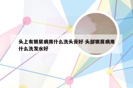 头上有银屑病用什么洗头膏好 头部银屑病用什么洗发水好