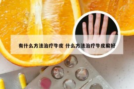 有什么方法治疗牛皮 什么方法治疗牛皮廨好