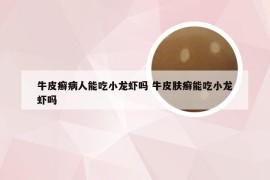 牛皮癣病人能吃小龙虾吗 牛皮肤癣能吃小龙虾吗