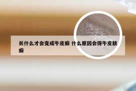长什么才会变成牛皮癣 什么原因会得牛皮肤癣